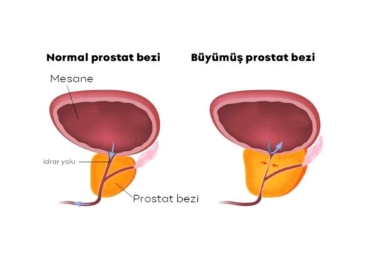 İyi Huylu Prostat Büyümesi (BPH) Nedir?