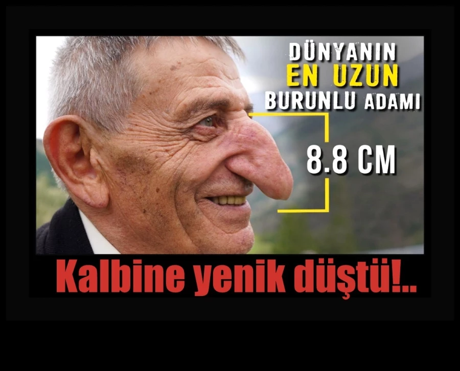 Dünyanın en uzun burunlu insanı Artvinli Mehmet Özyürek kalbine yenik düştü